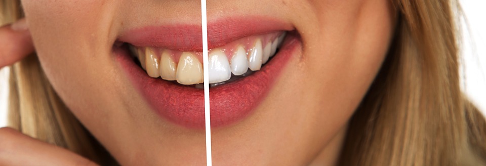 whitening teeth