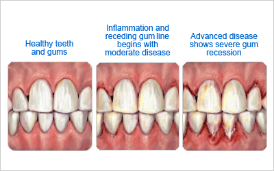 periodontal disease